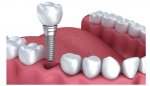 trong-rang-implant-co-duoc-bao-hiem-tri-tra-khong.jpg